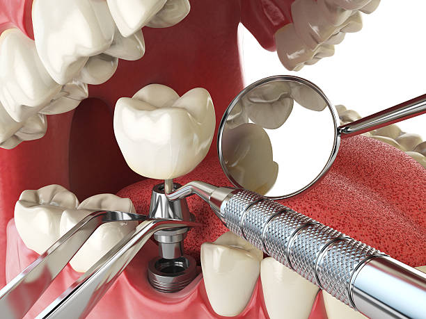Best Chipped Tooth Repair Near Me  in Miami, AZ